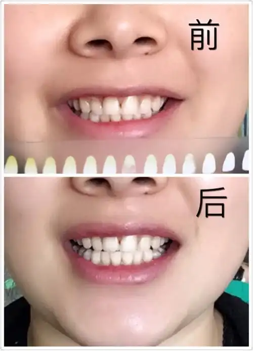 牙齿冷光美白!效果看得见!