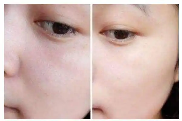 收缩毛孔最佳方法收缩毛孔用什么比较好