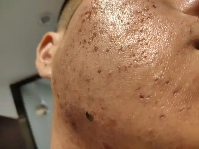 去痘印痘坑经历