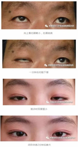 眼睛睁不开是得了重症肌无力吗_重症肌无力_重症肌无力症状 - 好大夫