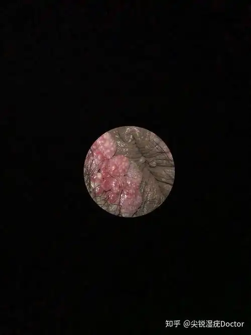 尖锐湿疣肛周疣体症状图片