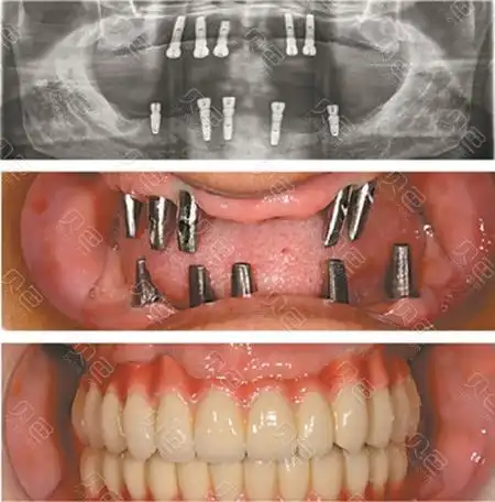 满嘴全部种牙我一想就很害怕,你们种牙疼不疼? - 贝色口腔