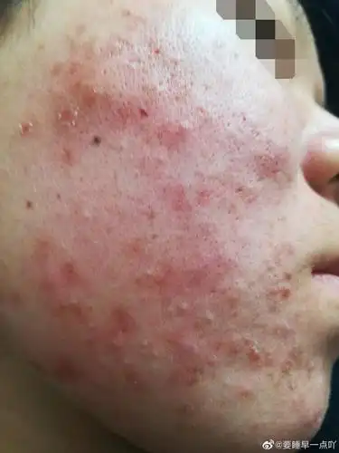 脸上由闭口粉刺发展成丘疹皮肤敏感泛红