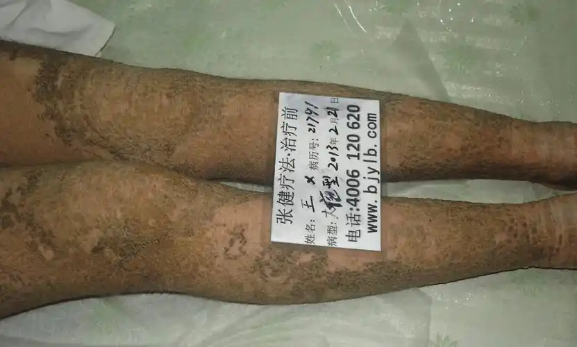 鱼鳞病症状表现是什么什么办法可改善鱼鳞病