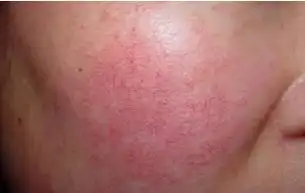 皮肤敏感泛红伴有红血丝怎么修复