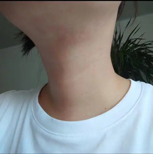 脖子上长了一片红点很痒一周了