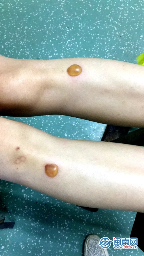 漳州多位市民艾灸后烫伤