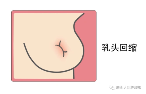 出现这些症状要警惕乳腺癌