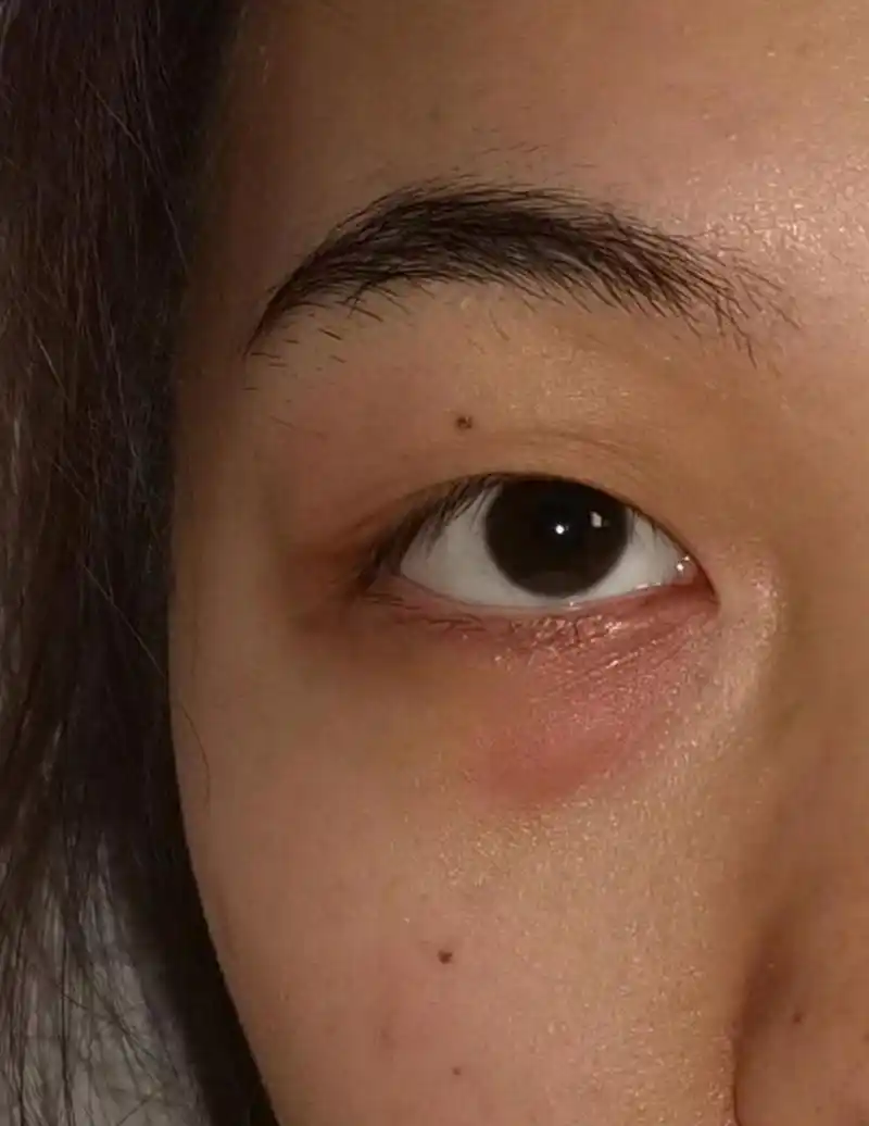 眼睛下面眼袋附近突然长红肿块 求助🆘中午吃完饭突然发现眼睛下面