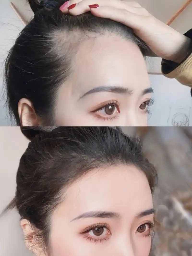 干货99秃头女孩救星96发际线粉瘦脸大法/完美丸子头推_圈子-新氧