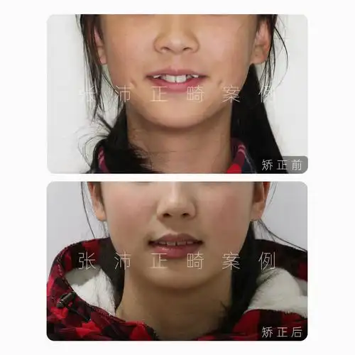 因此,拔虎牙时要持慎重态度,以求保持颜面丰满的长远效应.