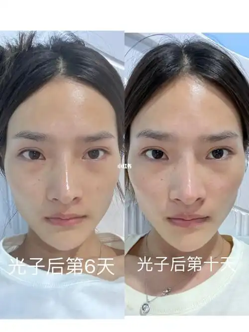 光子嫩肤做后十天效果
