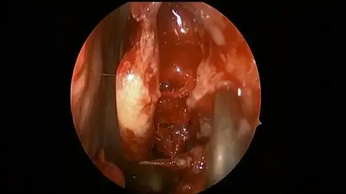 图文解说真菌性鼻窦炎的诊断与治疗