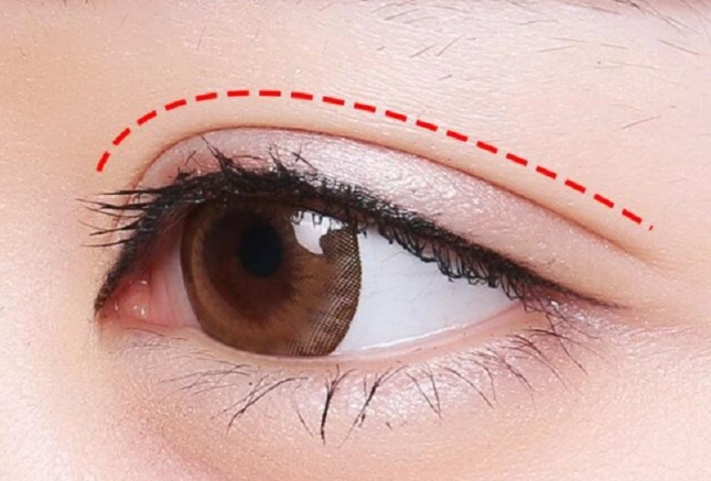 医疗美容科普双眼皮的形态有哪几种哪种类型好看些
