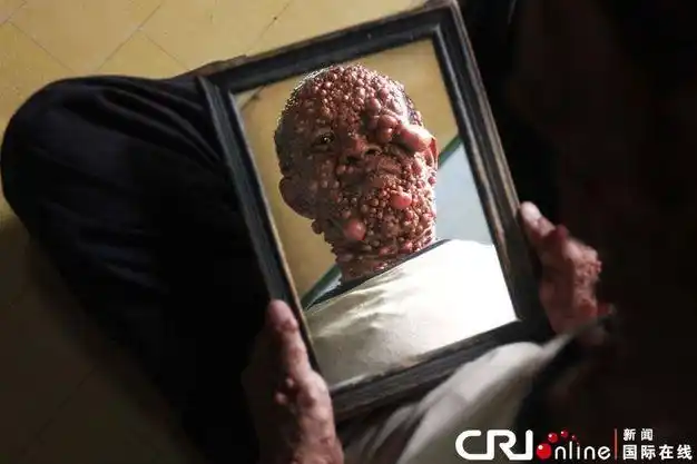 印尼男子患罕见疾病全身长满肿瘤形似泡泡人