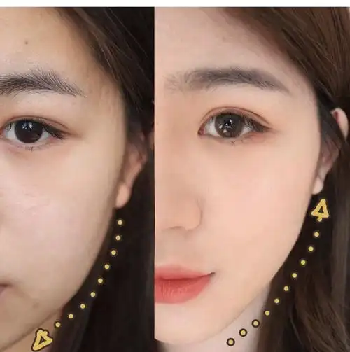 脸部提升前后对比图.