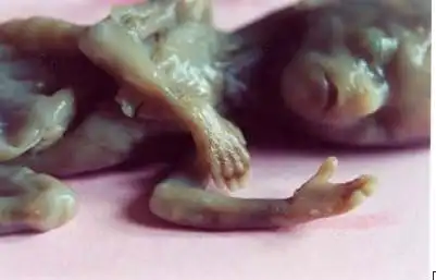 打胎后胎儿的真实照片,胎儿也是生命,打胎就是扼杀生命!