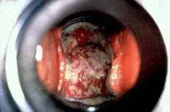 其次,白带呈白色稠厚豆腐渣样!再者,阴道黏膜红肿,严重的形成浅溃疡!