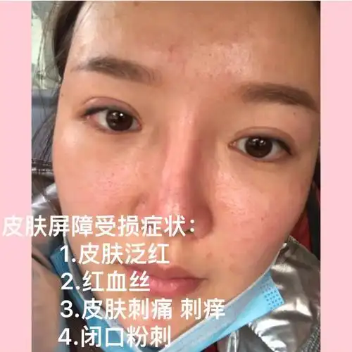 皮肤屏障受损——让肌肤修养生息,辅助用医学护肤品