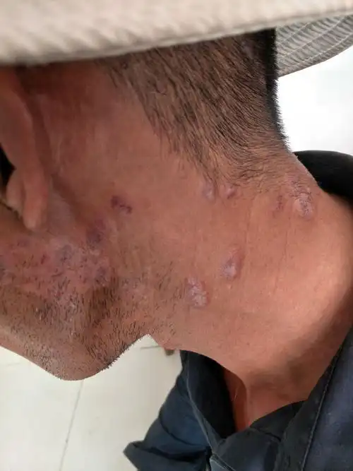 慢性日光性皮炎(慢光化)