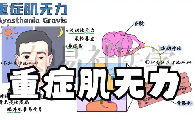 重症肌无力:挑战与希望并存的神经肌肉疾病