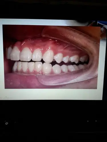 牙合学基础概念篇尖牙保护牙合