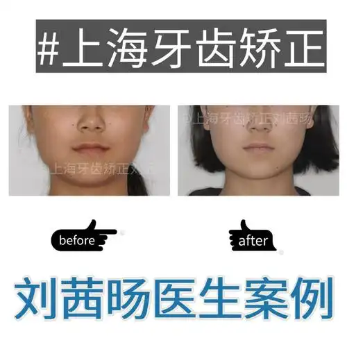 🌟【青少年矫正案例:虎牙异位萌出】
