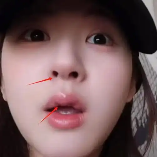 赵露思整容疑云再起,网友指认医美痕迹