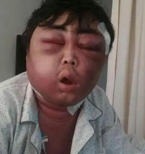 【肾病——风水相搏型水肿的症状,症候,治.