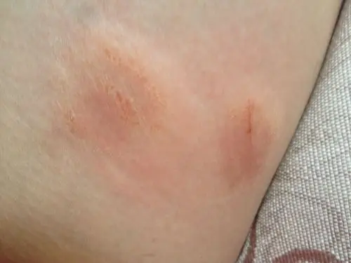 五六年来每年夏天都会出现这种体癣主要分布在大腿内侧偶尔