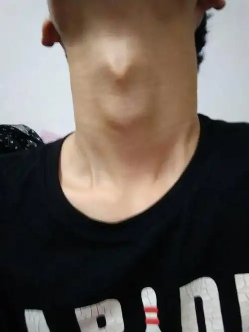 脖子松弛,喉结上面里面长了个半圆小硬块