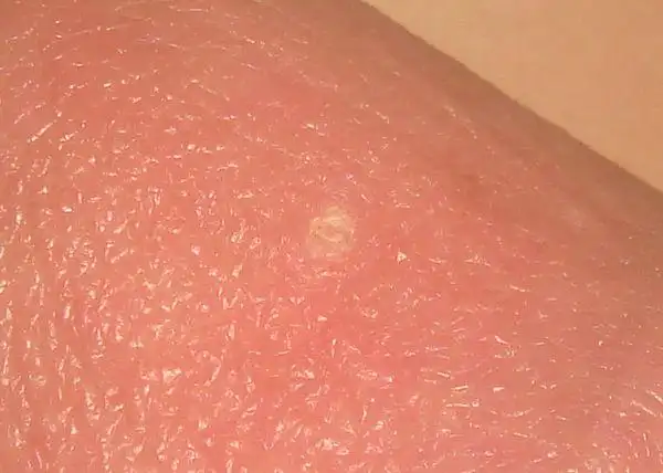 龟头上有一个白色圆环状小圈,直径一毫米,硬质,不痛不痒.时间有2年了.