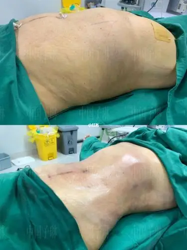 威塑腰腹环吸做完_腰腹_环吸_吸脂_双c_减肥_减肥医药