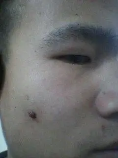 脸上长了个肉疙瘩怎么办.