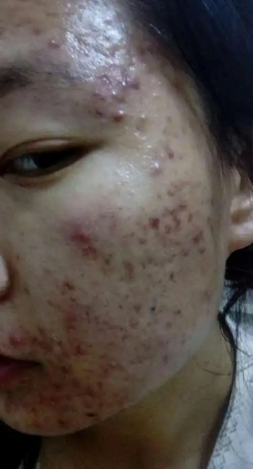 关于痘痘肌肤的小女孩