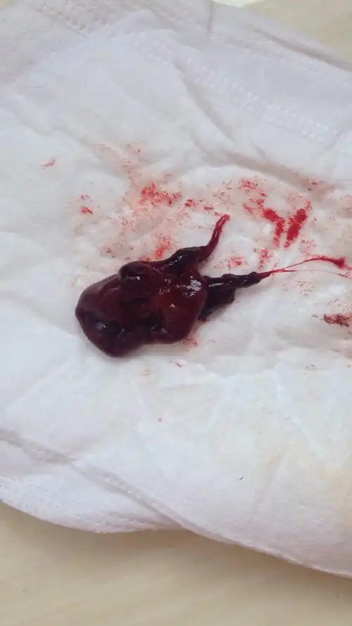 怀孕41天,流出来一块东西,不知道是生化还是流产了