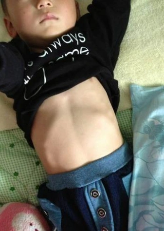 儿童佝偻病症状图片 (26)_有来医生