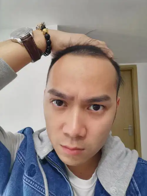 发际线太高怎么办