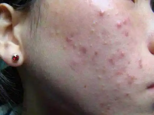 小小的生姜,每晚擦擦脸,痘痘掉光光,肌肤嫩似小女孩儿!