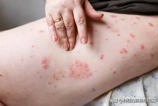 这些皮肤病,预示着早期肝癌!