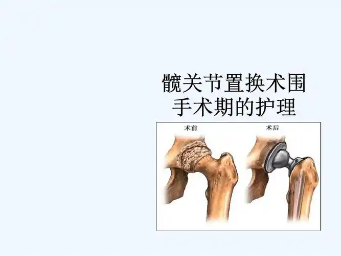 髋关节置换术围手术期的护理ppt[文字可编辑].ppt