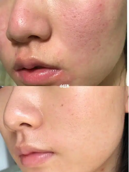 原相机对比图不同类型毛孔粗大如何拯救71