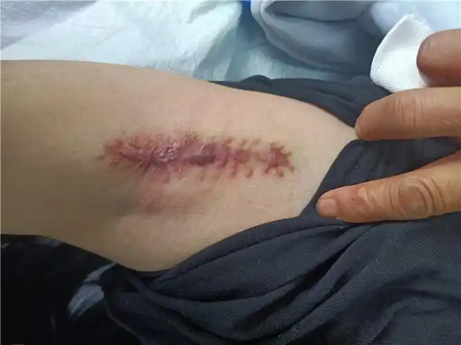 是在腋窝作一长约1-2cm的小切口,然后在腋下大汗腺分布区进行局部麻醉