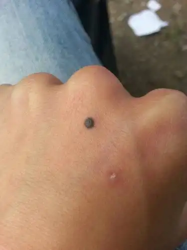 我手背上有了痣,像纹身的那种青色现在好几年了,这痣慢慢的变大,不
