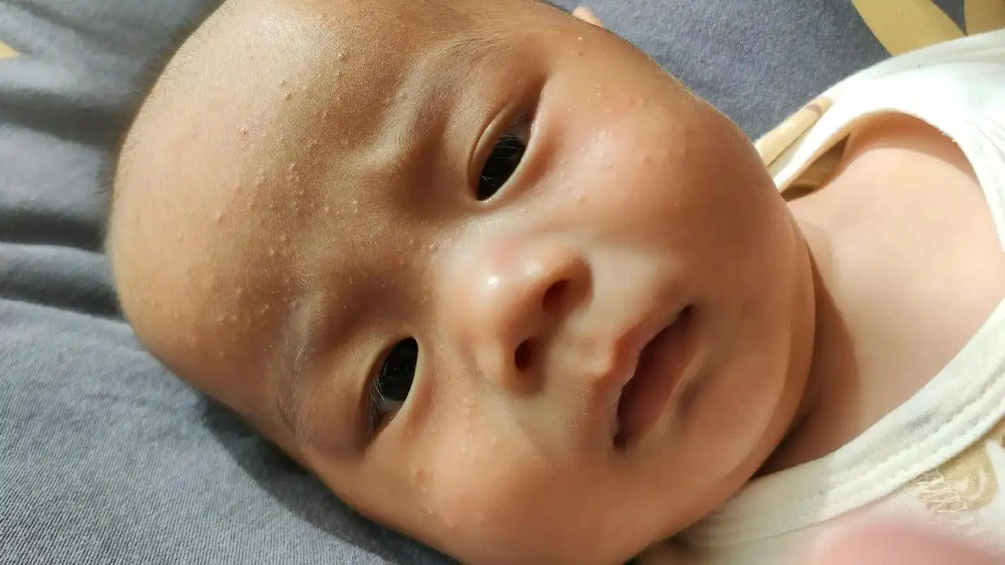 到底是啥.#痤疮吗#湿疹吗   从出生半个多月就开始长快三个 - 抖音