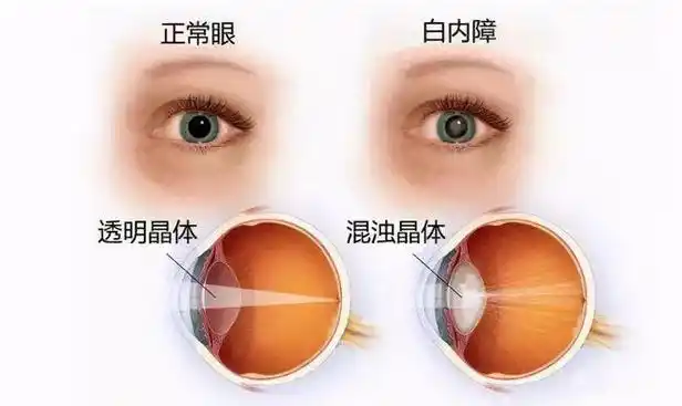 成都爱尔周进院长解析高度近视可能引发哪些疾病|视网膜|青光眼|玻璃