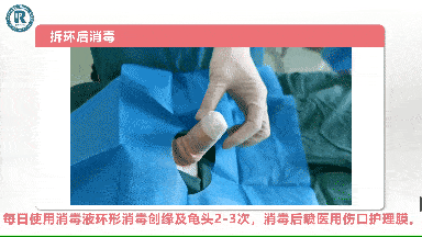 有一份"包皮环切"术后家庭护理指南"拍了拍"你_手术