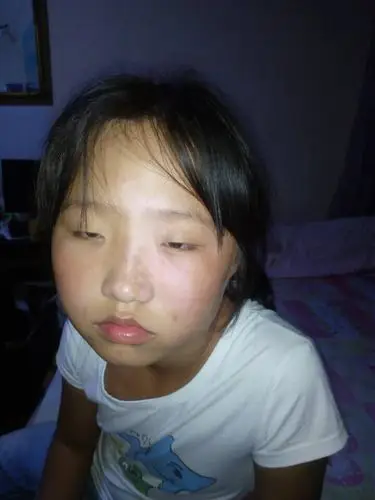 面部局部皮肤变白确诊为白癜风血常规检查都正常