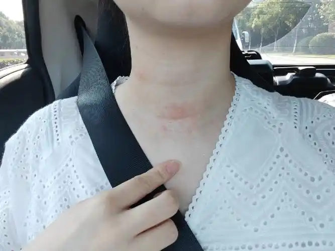 孕期过敏?还是湿疹?简直太难受了