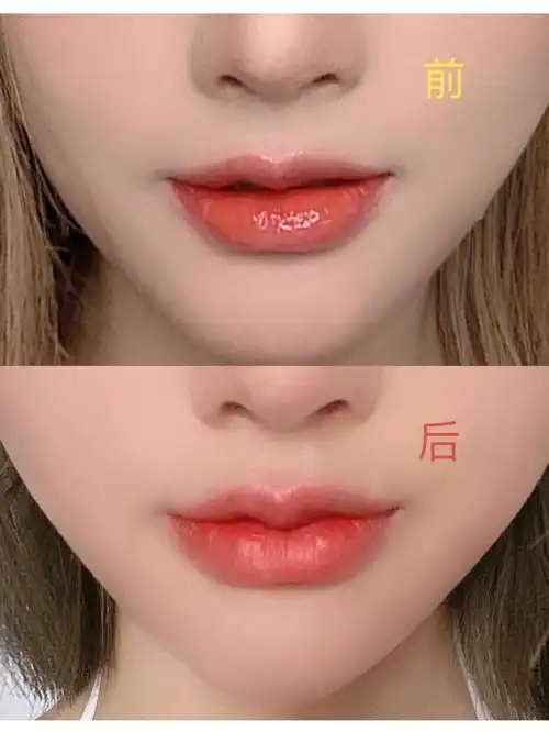 玻尿酸丰唇即刻效果对比